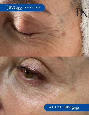 juvelook до та після 1