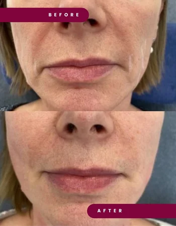 lenisna до та після 3