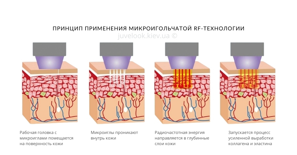 RF-лифтинг Morpheus 8