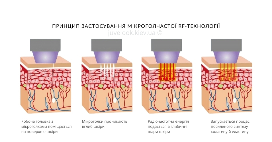 RF-ліфтинг Morpheus 8