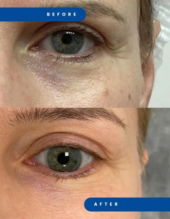 juvelook дои после 2