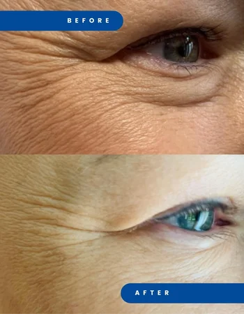 juvelook дои после 4