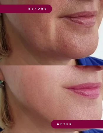 lenisna дои после 2