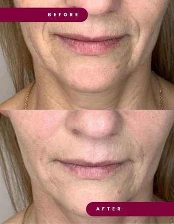 lenisna дои после 4