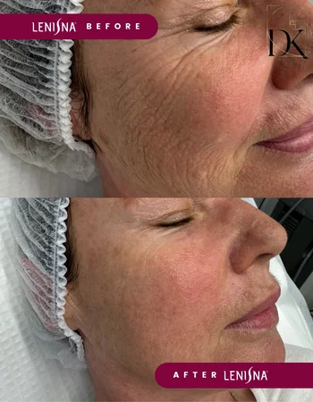 lenisna дои после 1